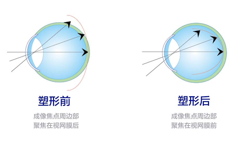 角膜塑形镜OK不OK？福州锐明爱尔眼科专家来解答